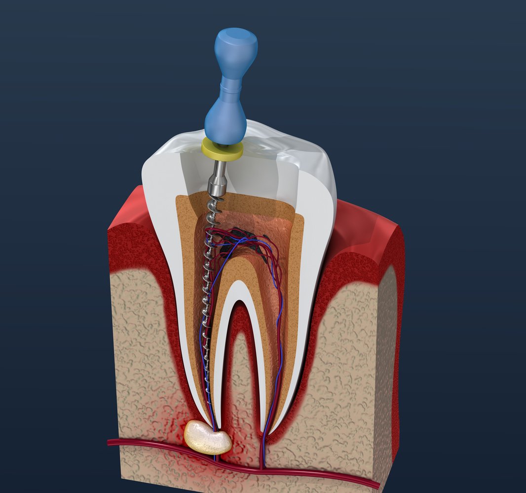 Root canal treatment process. 3D illustration