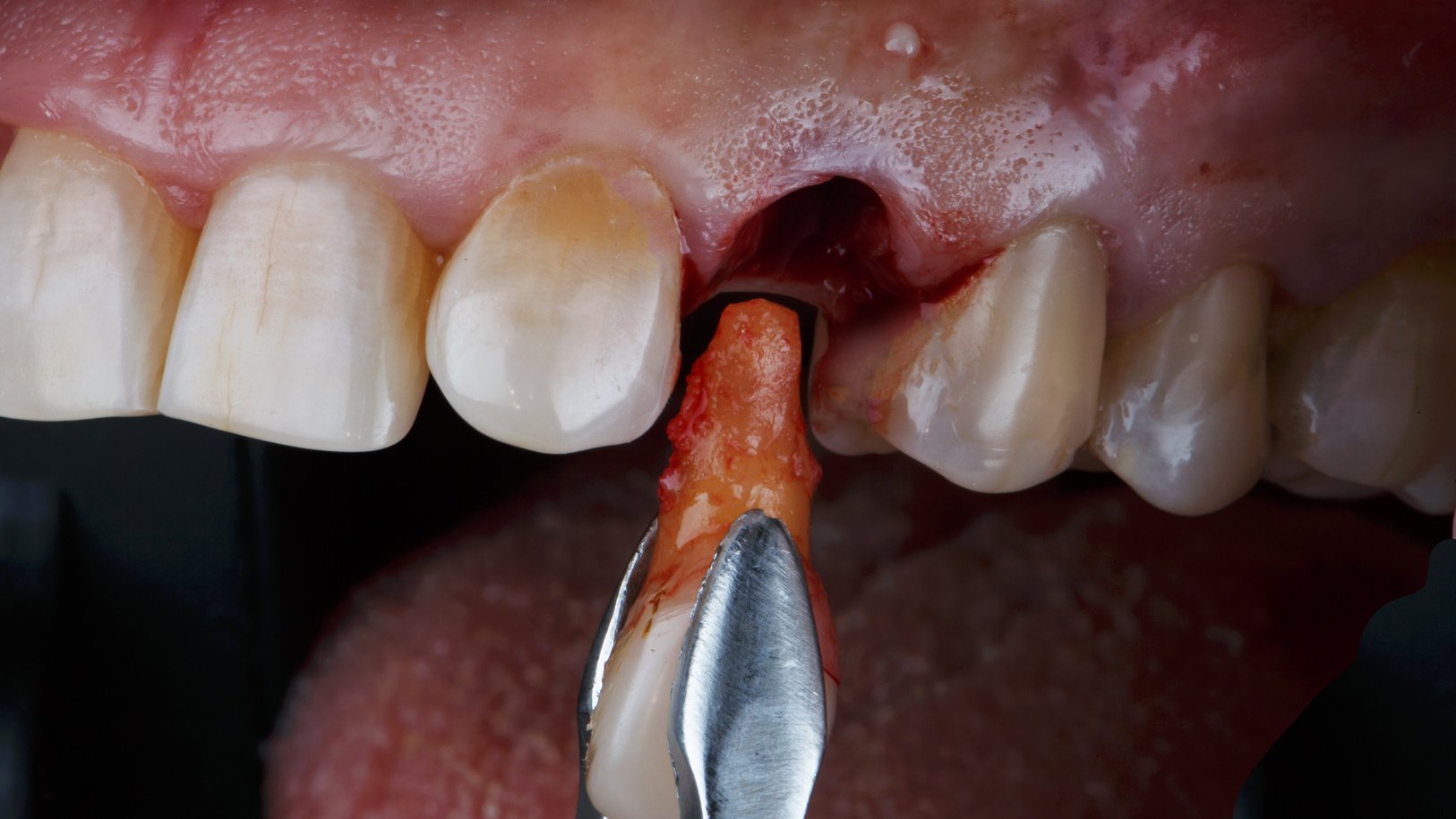 Creative Photo of Tooth Extraction with Root before Implantation